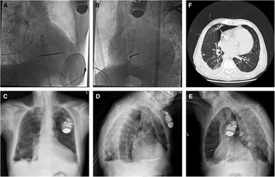 Atrial lead perforation early after device implantation—a case report and literature review